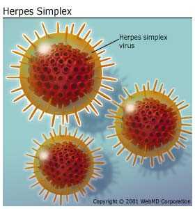 Genital herpes natural topical treatment natural